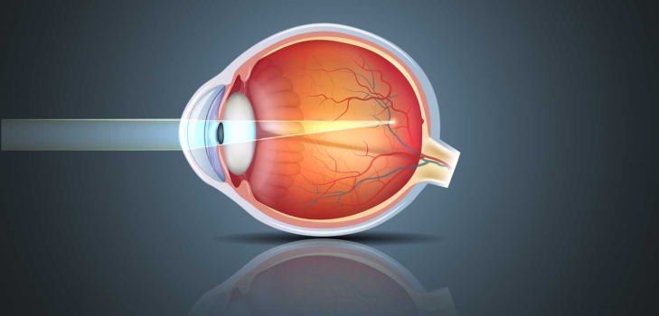 What are the Different Types of Myopia?