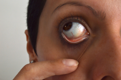 Understanding Blepharospasm (eyelid twitches)