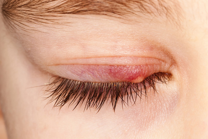 What is a Stye & How to Treat It