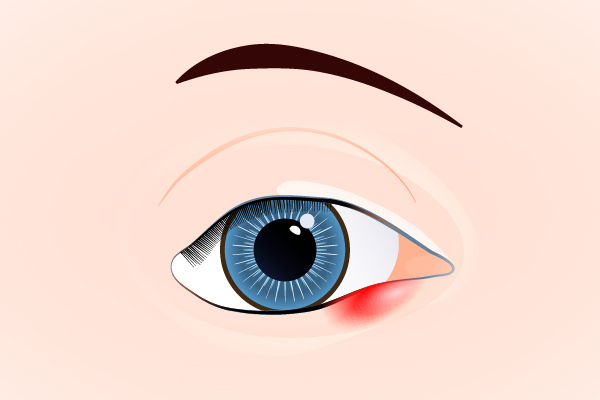 What causes a stye?