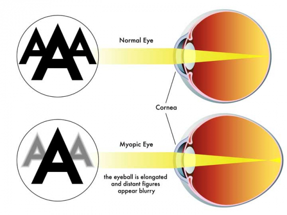 Diagram to show a myopic eye and an eye without myopia