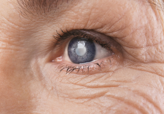 Close up of an eye showing cataract formed in lens