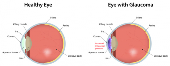 Diagram showing the difference between an eye with normal vision and an eye with glaucoma